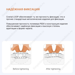 Краниофиксатор Neos Surgeru CRANIAL loop (XL) для краниопластики и трепанации черепа